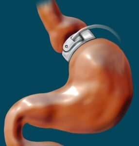 Gastric Banding Surgery: All You Need To Know