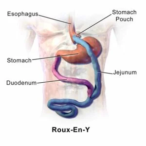 Gastric Bypass