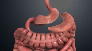 Alternatives to Gastric Banding Surgery