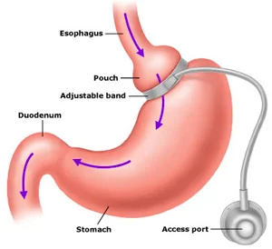 Gastric Banding