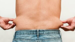 Loose Skin After Weight Loss: Reasons and Treating It