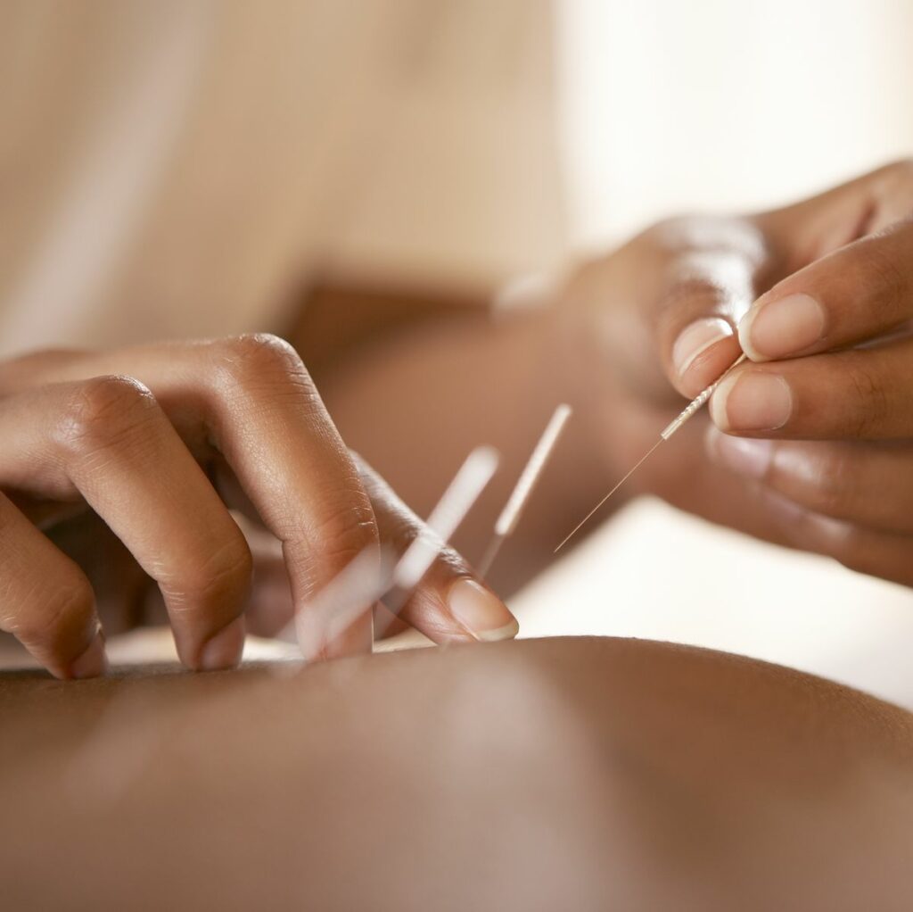 Acupuncture for Weight Loss: What You Need to Know